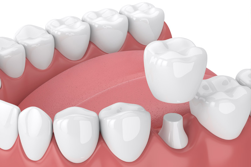 Tooth Colored Dental Crowns in Anaheim